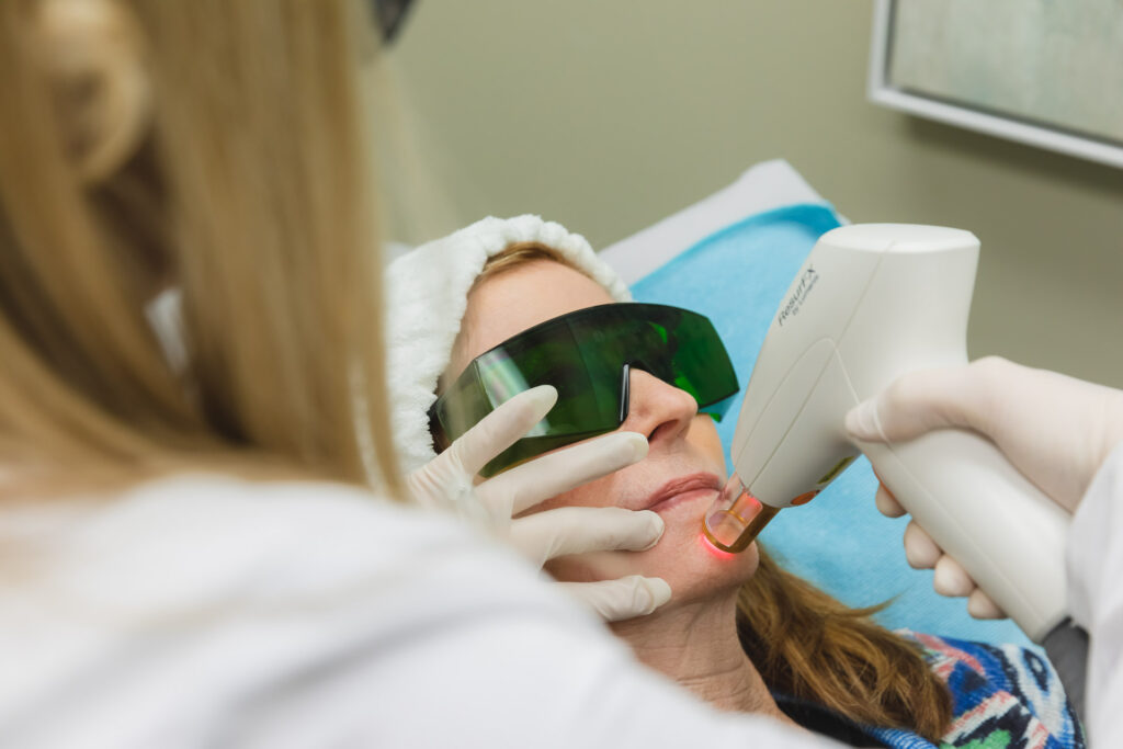 Laser skin resurfacing treatment at Catara Med Spa in Algonquin, IL. Rejuvenating facial therapy for smoother, more youthful skin. Acne Scar Hyperpigmentation