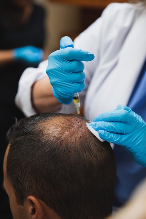 PRP injection into scalp for hair regrowth at Catara Med Spa in Algonquin, IL. Non-surgical treatment for thinning hair by medical professional.
