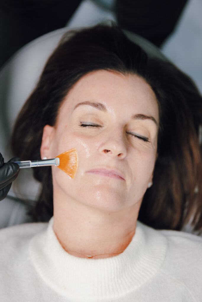 Client receiving a chemical peel at Catara Med Spa in Algonquin, IL. Exfoliation treatment for discoloration, texture, and fine lines.