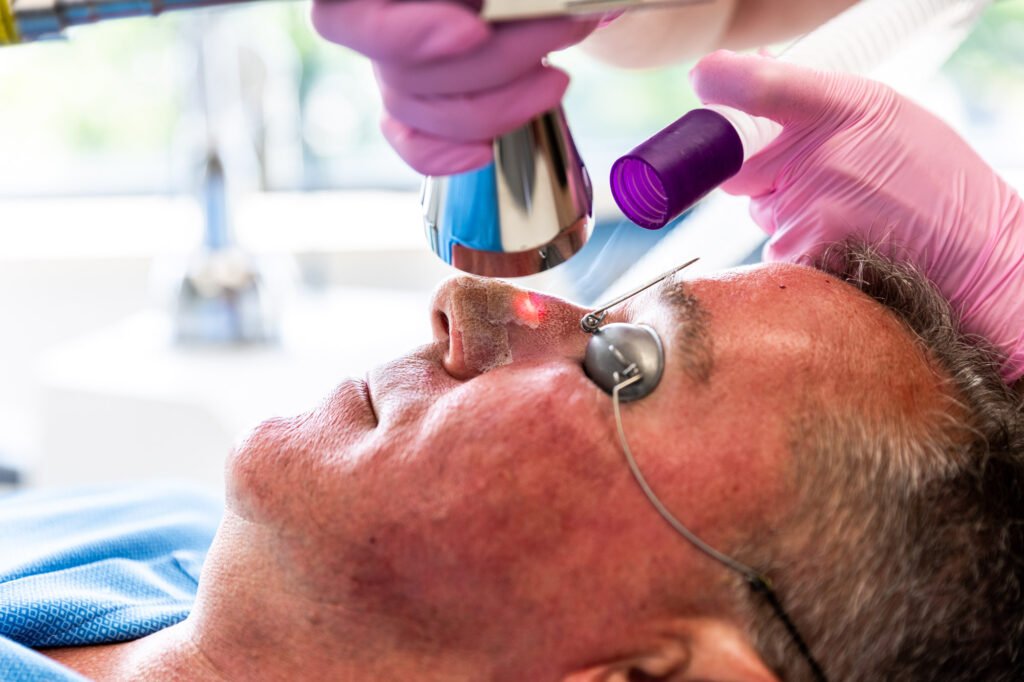 Close-up of Sciton Halo laser treatment in progress at Catara Med Spa in Algonquin, IL, visibly resurfacing the skin for rejuvenation.