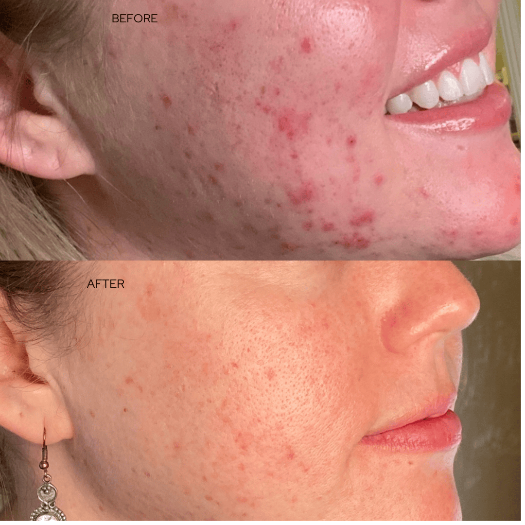 Before and after acne treatment side profile results at Catara Med Spa in Algonquin, IL showing smoother, clearer skin.