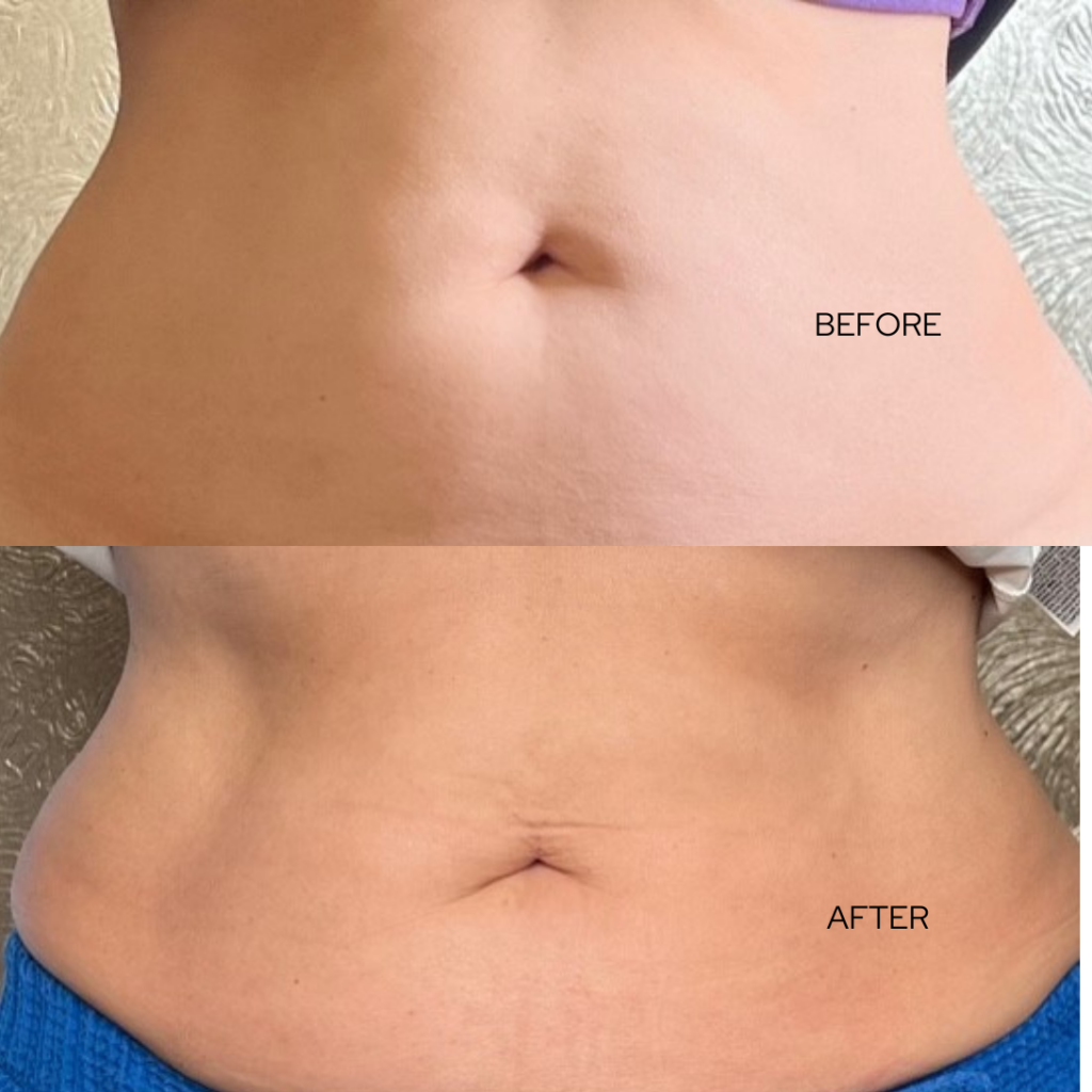 Before and after results of abdominal body contouring at Catara Med Spa in Algonquin, IL showing improved tone and reduced fat.