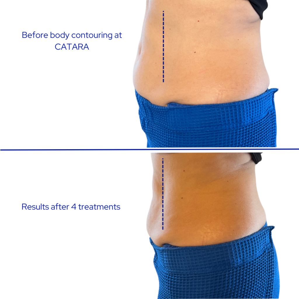 Before and after body contouring results after four treatments at Catara Med Spa in Algonquin, IL showing visible fat reduction on the abdomen.