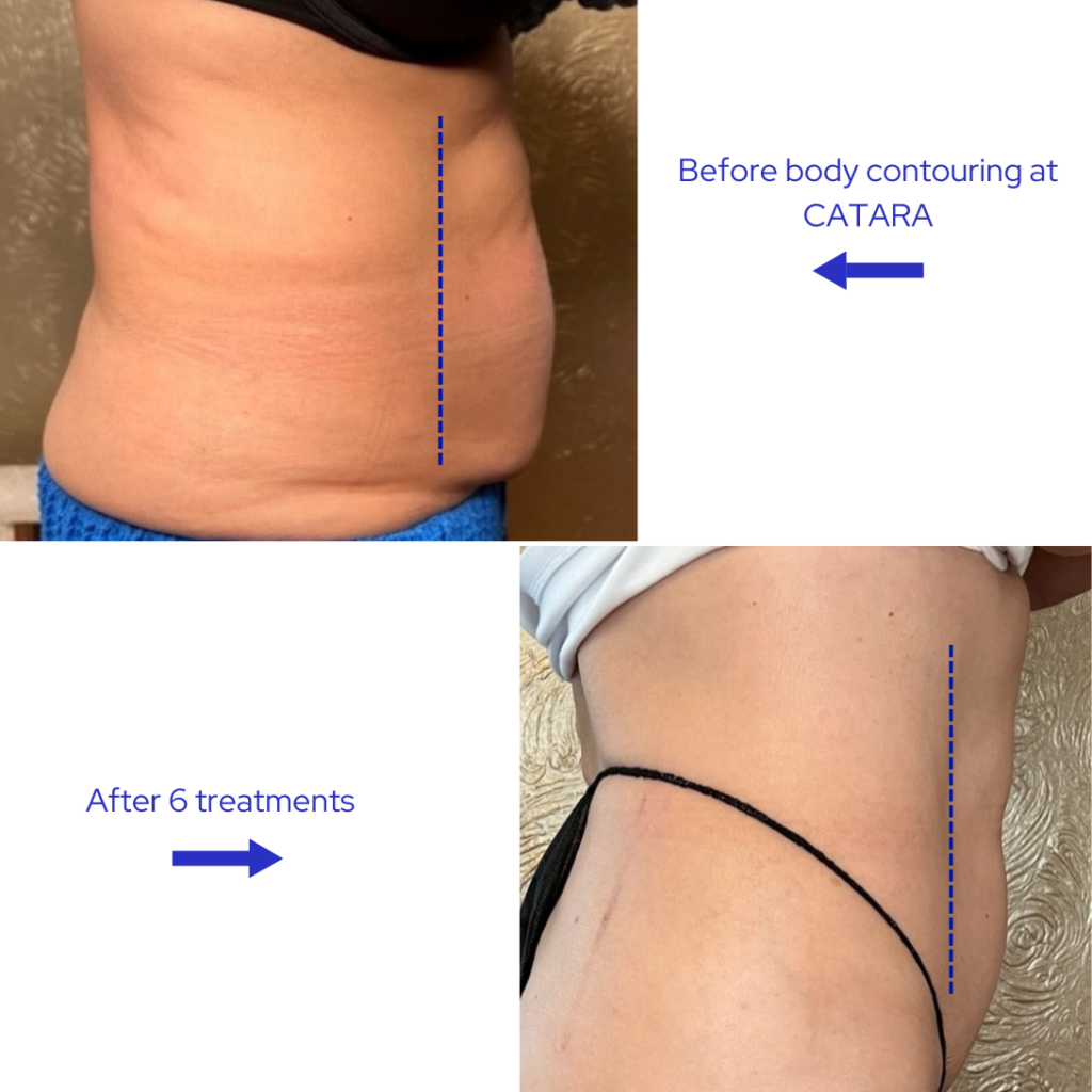 Before and after side view of body contouring results at Catara Med Spa in Algonquin, IL after six non-invasive treatments.