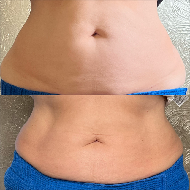 before and after abdominal body contouring with emsculpt neo at catara med spa in algonquin il showing visible fat reduction