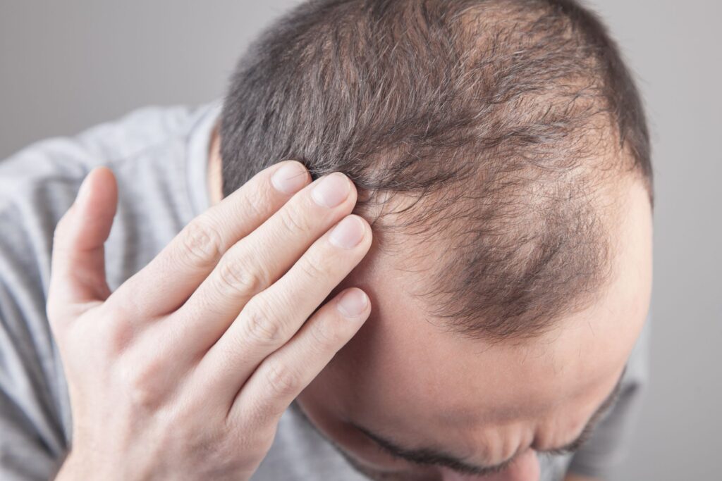 Man examining thinning hairline, showing early signs of hair loss