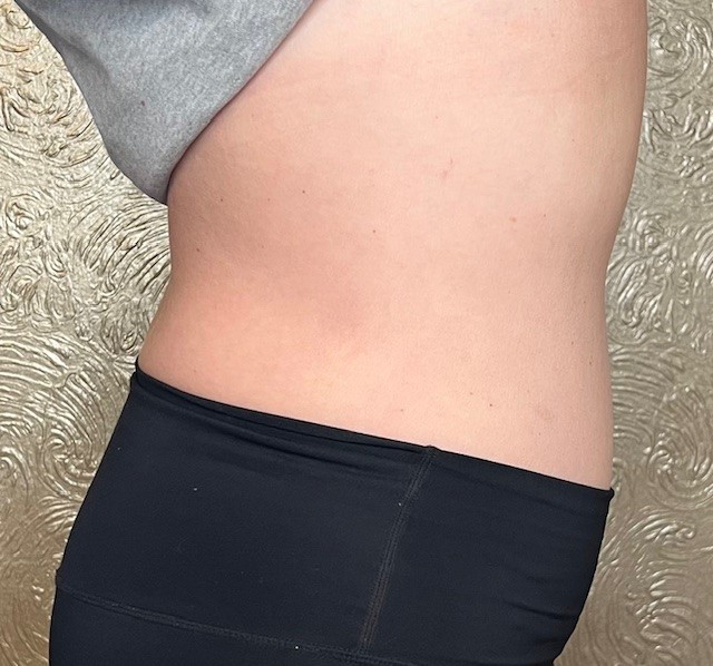 After weight loss treatment at Catara Med Spa in Algonquin, IL. Slimmer waist following Semaglutide, wood therapy, and nutrition support.