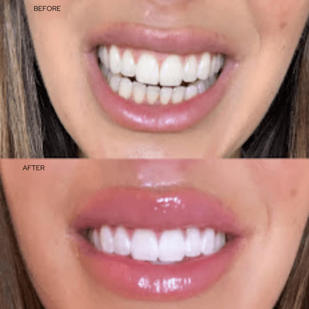 Before and after teeth whitening results at Cátara Med Spa in Algonquin, IL. Professional treatment for a visibly whiter, brighter smile.