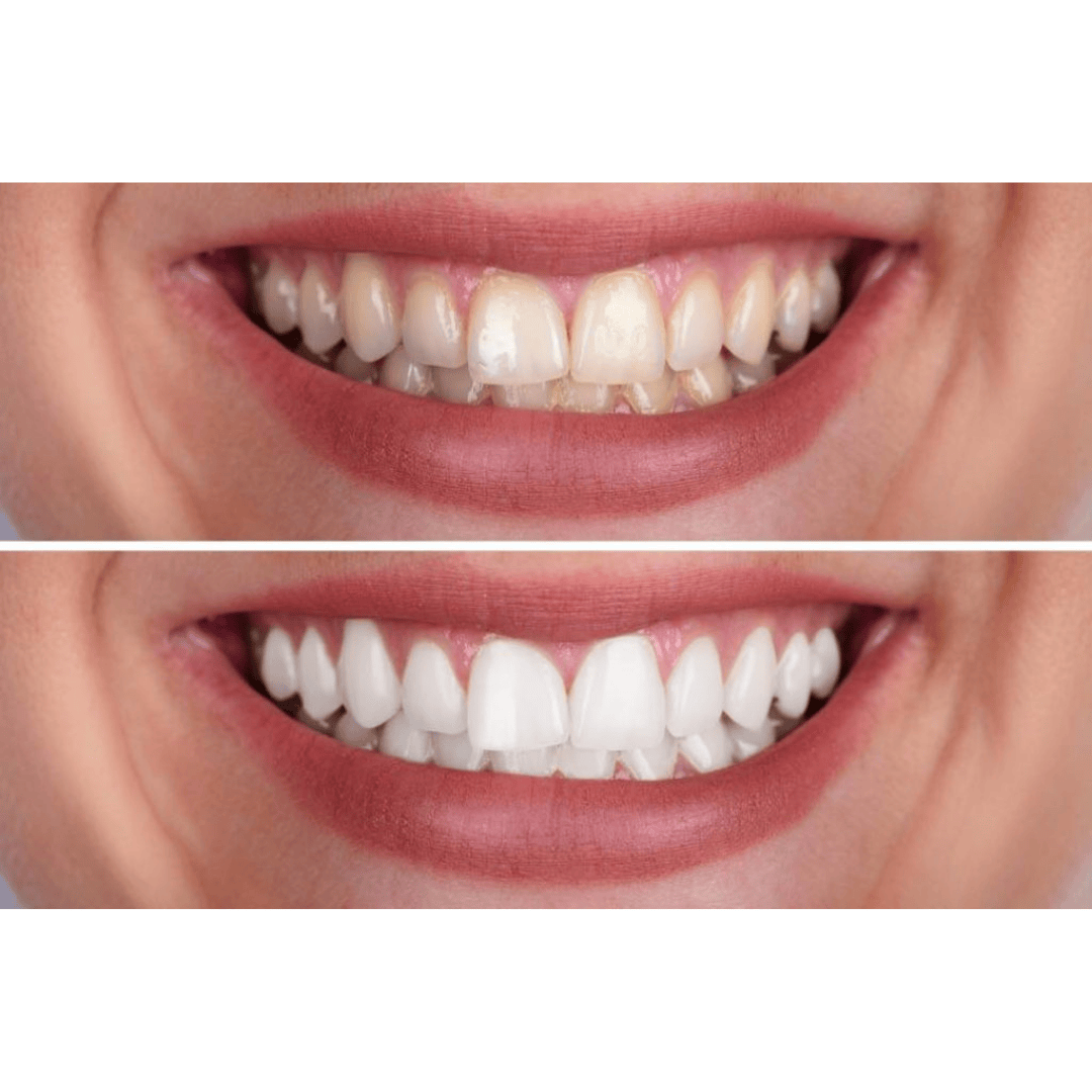 Before and after smile showing teeth whitening near me results at Catara Med Spa in Algonquin, IL with visibly whiter, brighter teeth.