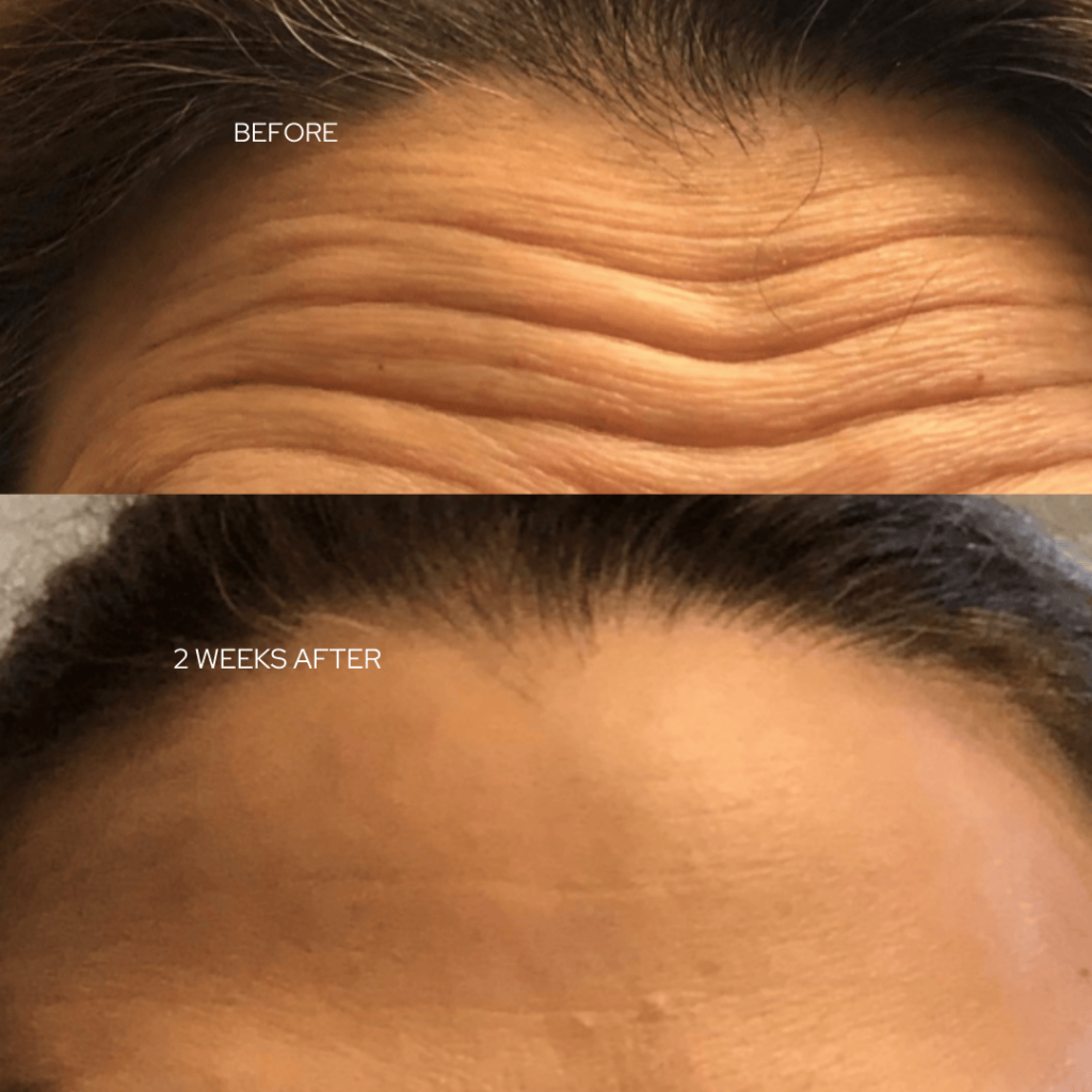 Before and after Botox results on forehead wrinkles at Catara Med Spa in Algonquin, IL — showing smoother skin after Botox near me.