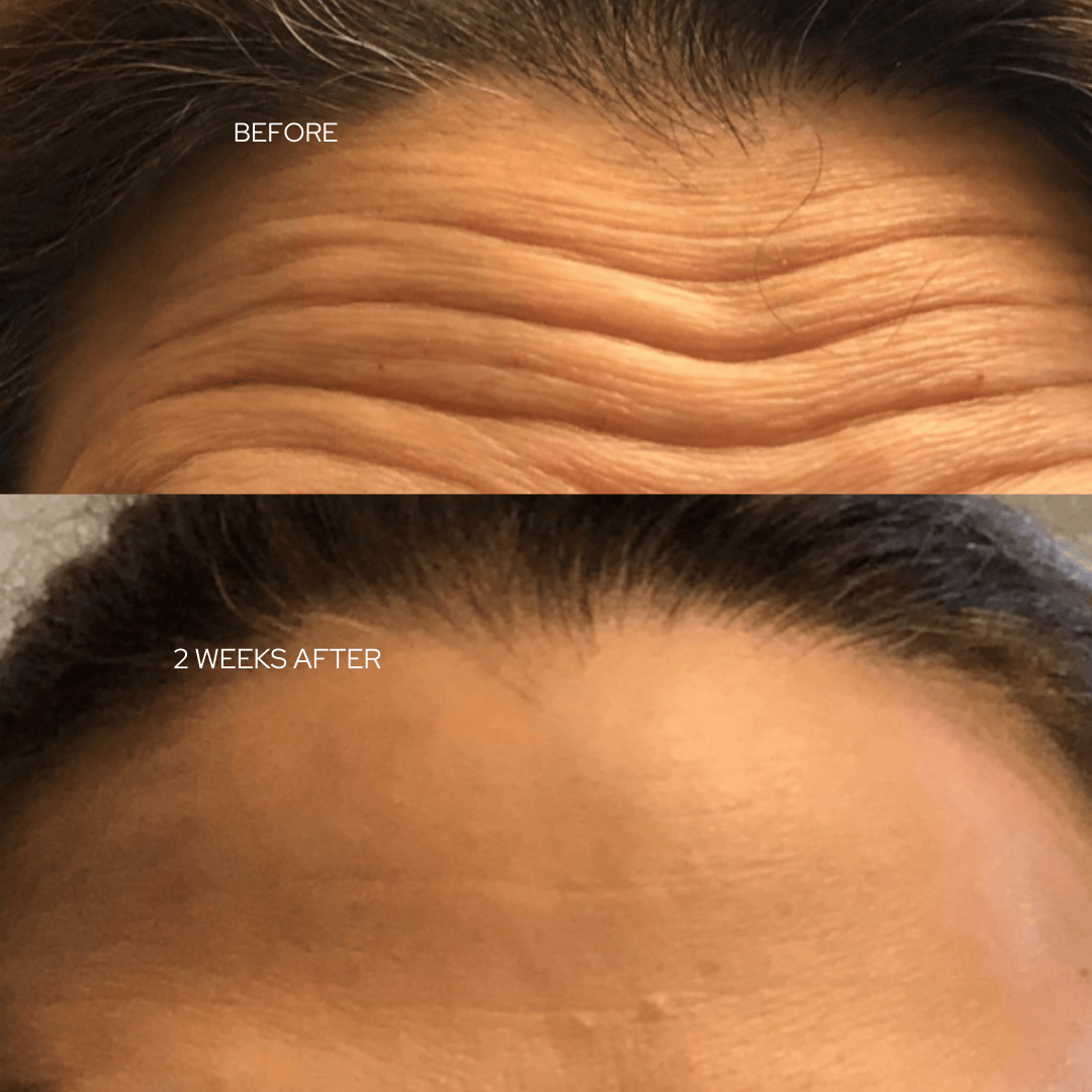 forehead before and after Botox treatment showing reduced wrinkles and smoother skin