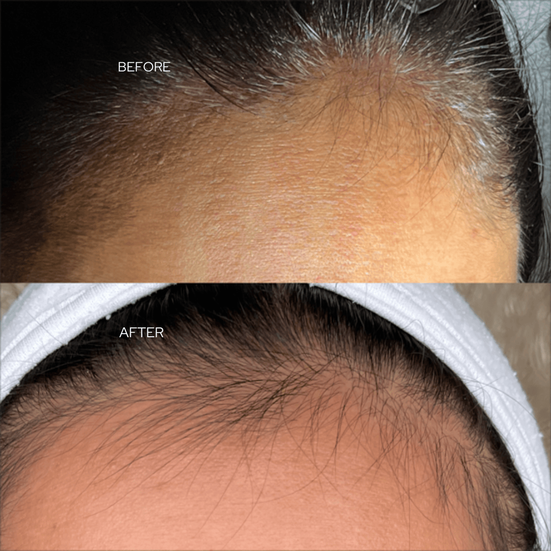 before and after image of hairline restoration showing visible hair regrowth along the forehead