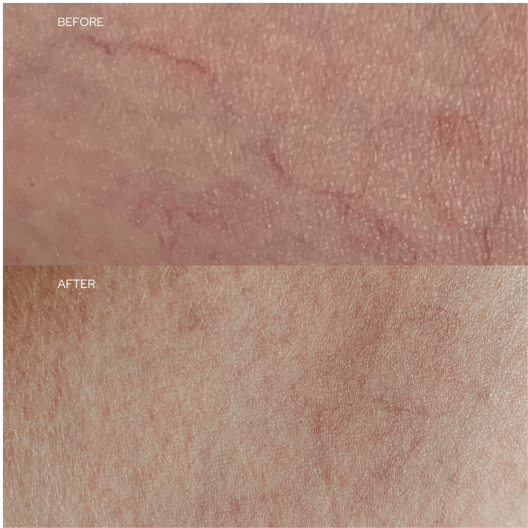 before and after laser treatment for facial redness and visible veins