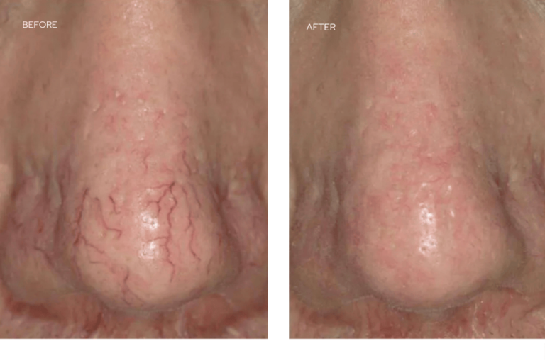nose before and after laser treatment showing reduction of visible broken capillaries and redness