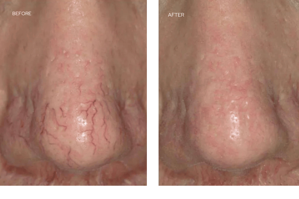 nose before and after laser treatment showing reduction of visible broken capillaries and redness