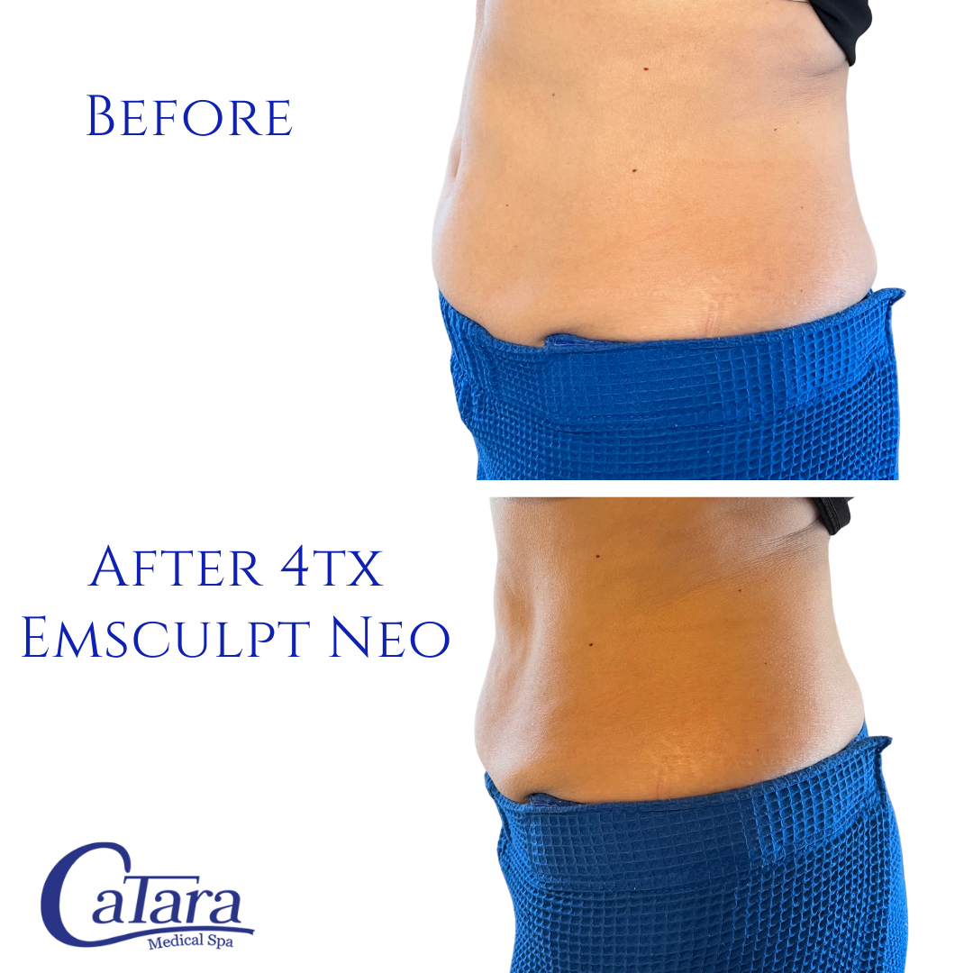 Before and after Emsculpt Neo treatment at Catara Med Spa, Algonquin, IL. Visible abdominal fat reduction and muscle toning after 4 sessions.