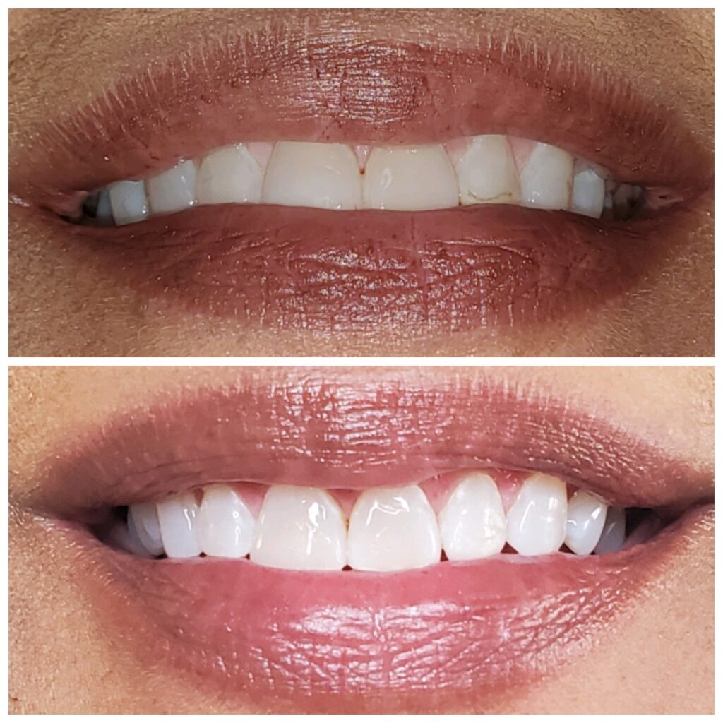 Before and after teeth whitening results at Catara Med Spa, Algonquin, IL. Whiter teeth and improved smile clarity with professional cosmetic care.