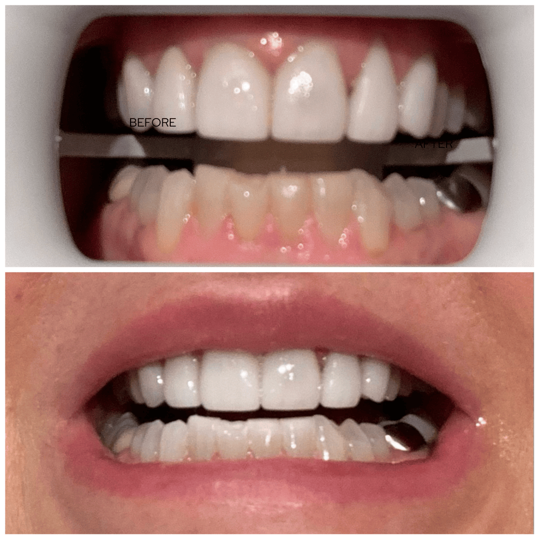 Before and after professional teeth whitening at Catara Med Spa in Algonquin, IL. Achieve a brighter, whiter smile with expert aesthetic treatments.