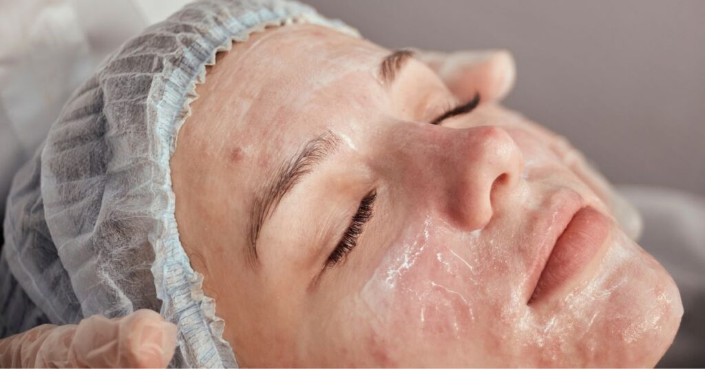 Client experiencing the benefits of an acne facial at Catara Med Spa, promoting clear, hydrated, and rejuvenated skin.
