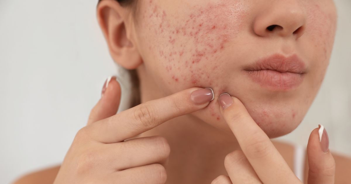 best acne treatment at Catara Med Spa in Algonquin, IL. Clearer skin results from customized facials, peels, and RF microneedling