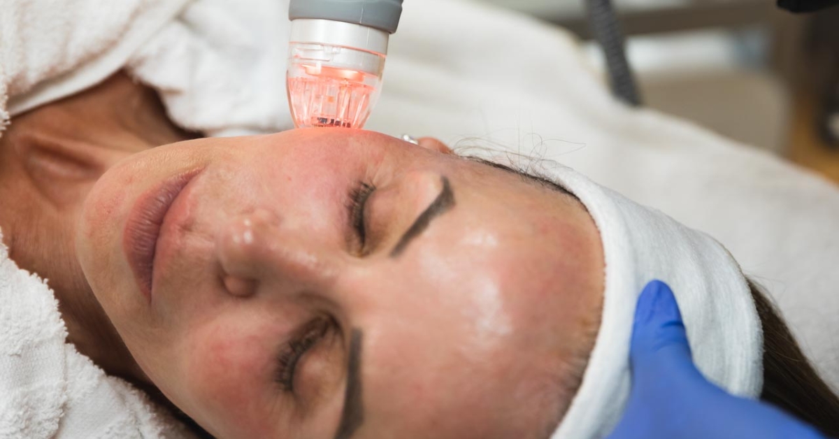 microneedling with PRP treatment at Catara Med Spa in Algonquin, IL. Collagen stimulation and skin rejuvenation for smoother, youthful skin