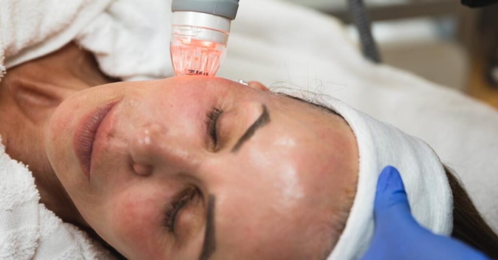 Combination PRP and microneedling treatment for acne scars and wrinkles