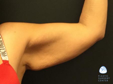 crepey arm skin tightening treatment algonquin