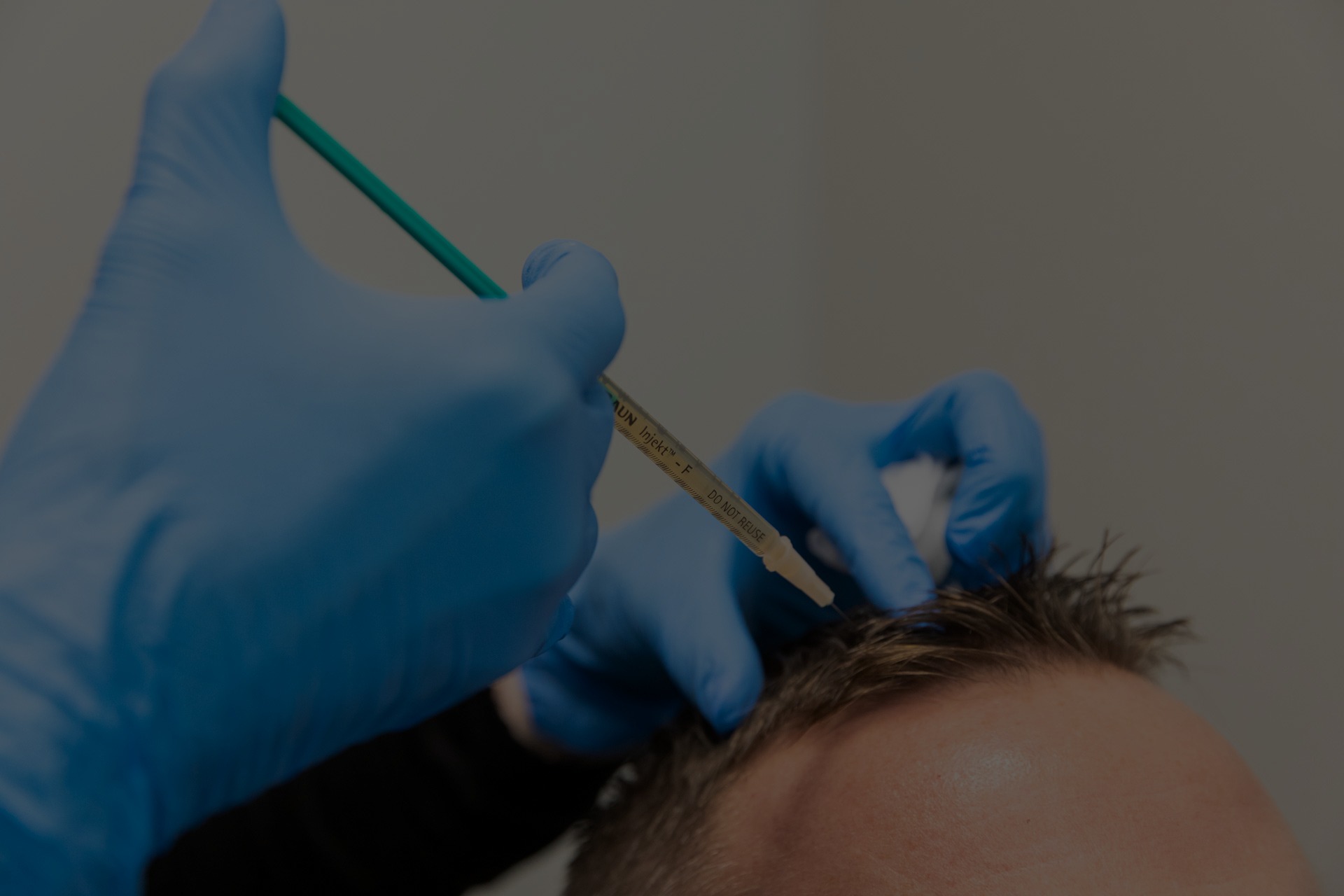 PRP injection treatment for male hair restoration at Catara Med Spa in Algonquin, IL. Non-surgical scalp therapy performed by licensed specialist.