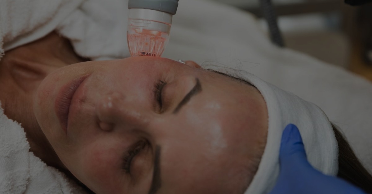 RF microneedling for collagen stimulation at skin clinic in Algonquin