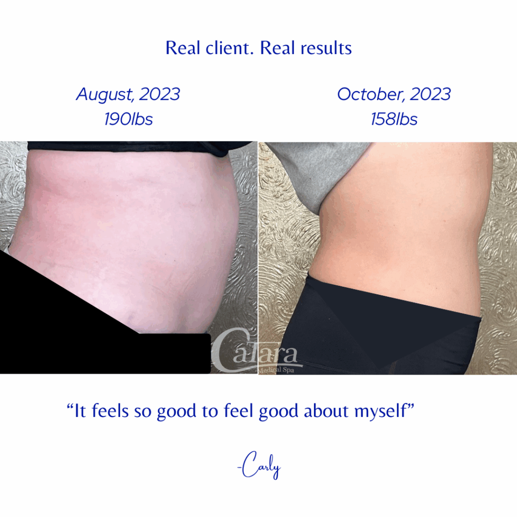 Weight loss results at Catara Med Spa in Algonquin, IL. Real client showing midsection slimming and improved contour through non-surgical support.
