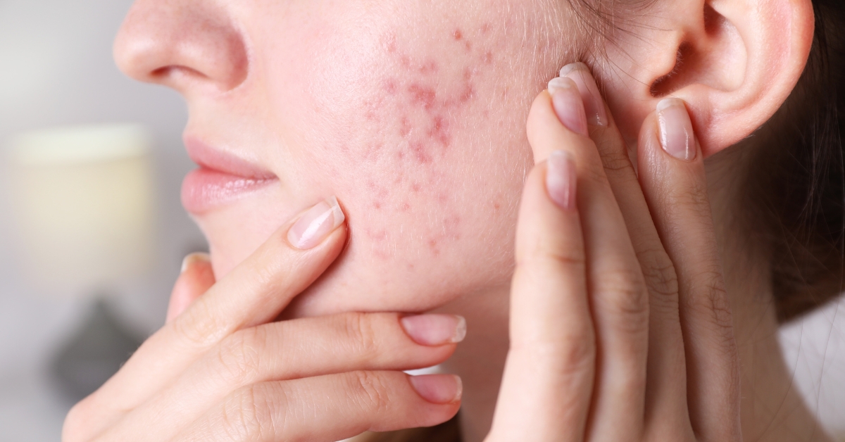 Close-up of acne scars and hyperpigmentation on cheek, ideal for treatment at Catara Med Spa.