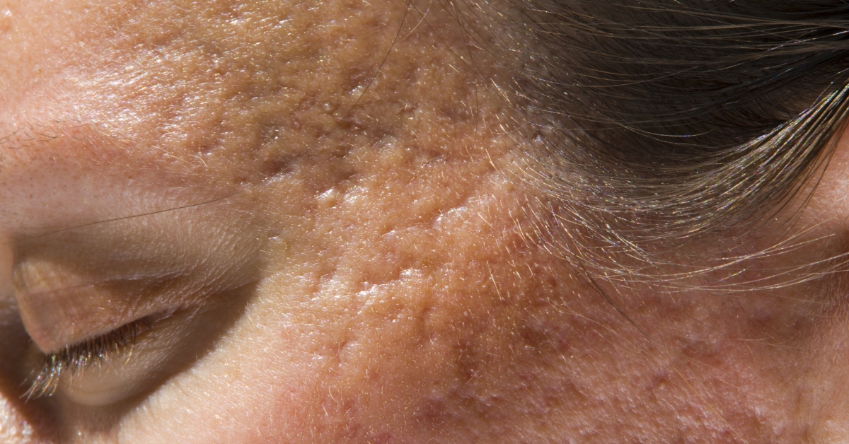 Targeted treatments for rolling acne scars at Catara Med Spa.