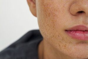 Extreme close-up of facial skin showing enlarged pores, acne scarring, and hyperpigmentation treatment- common concerns treated at CATARA Med Spa in Algonquin, IL.