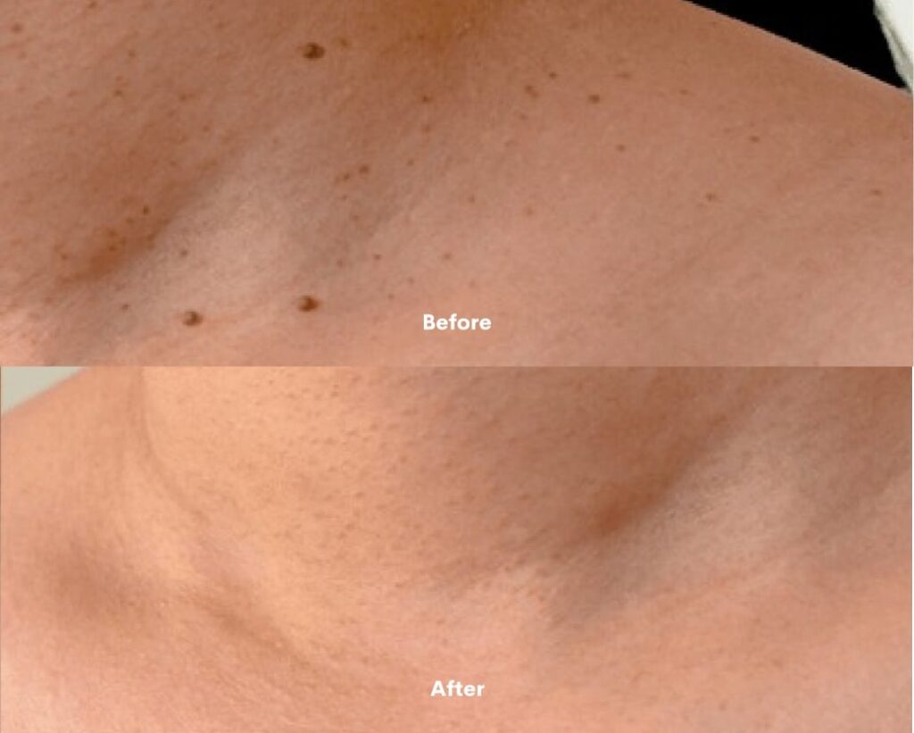Cherry angioma removal before and after results at Catara Med Spa in Algonquin, IL. Clear, even-toned skin after precise vascular treatment.
