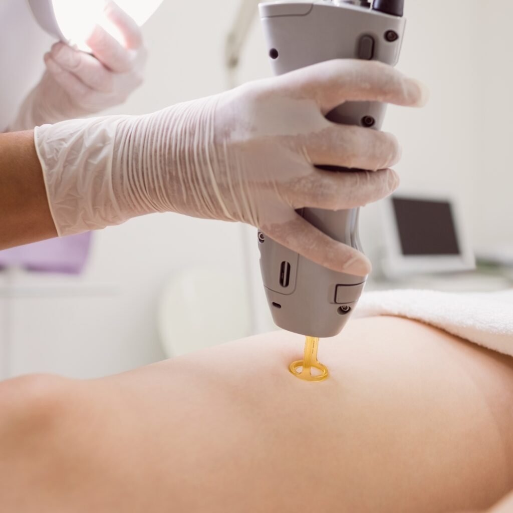 Laser treatment for cherry angiomas at Catara Med Spa in Algonquin, IL. Safe vascular lesion removal with advanced precision technology.