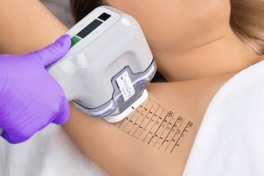 miraDry treatment for underarm sweat reduction at Catara Med Spa in Algonquin, IL. Non-surgical, permanent sweat and odor control solution.