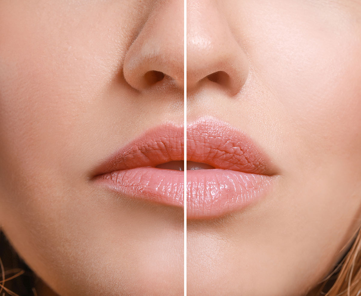Lip filler before and after results at Catara Medical Spa in Algonquin IL