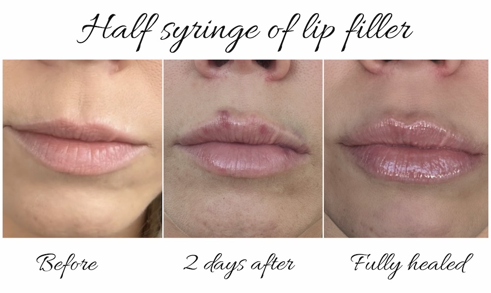 Lip Filler Bruising Recovery Timeline