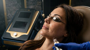 Sylfirm X RF microneedling device at Catara Med Spa in Algonquin, IL