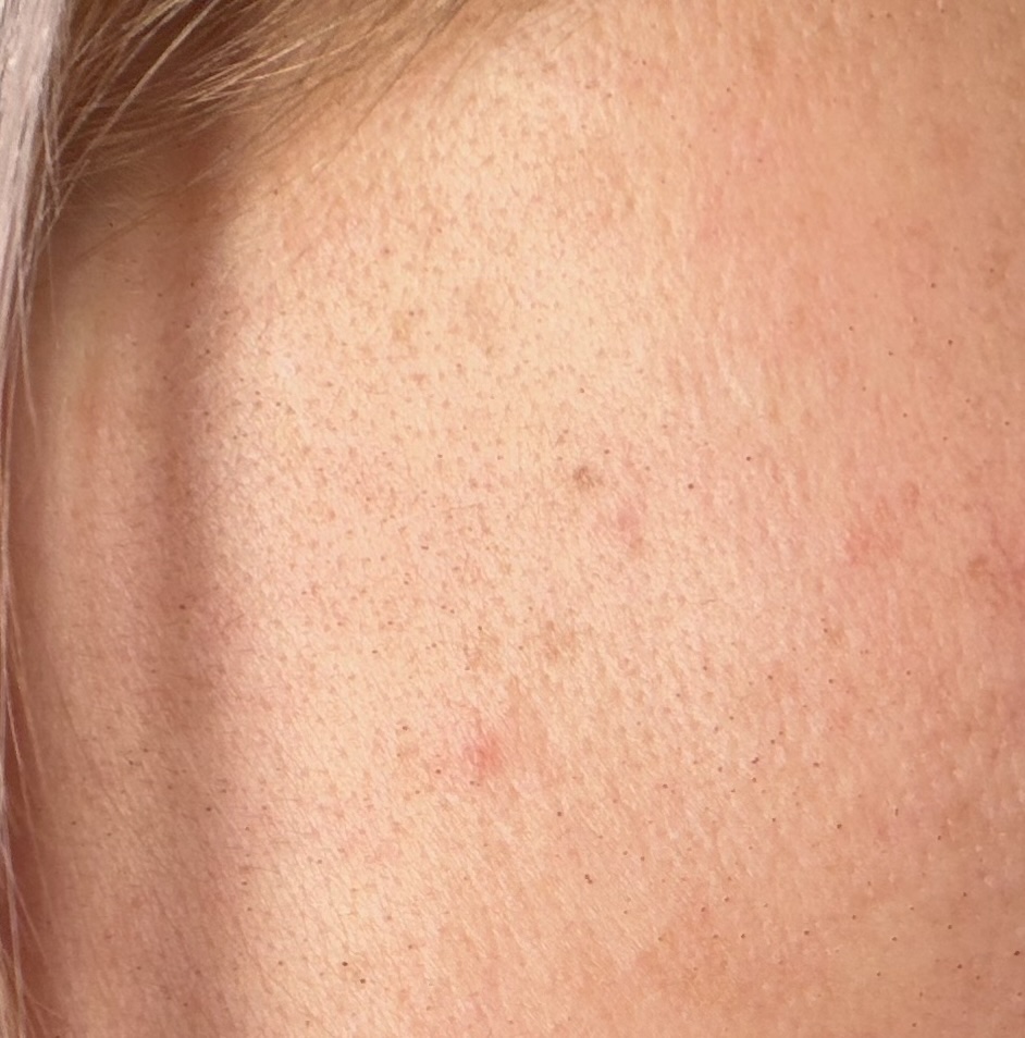 sylfirm x grid pattern after treatment catara